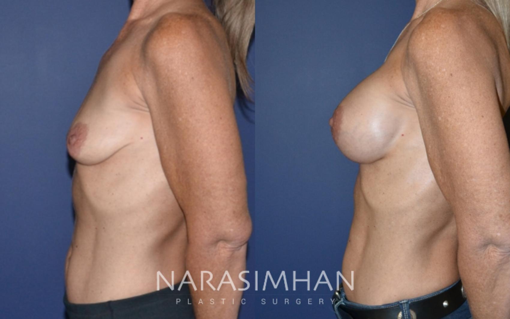 Before & After Breast Augmentation Case 147 View #3 View in St Petersburg, Florida