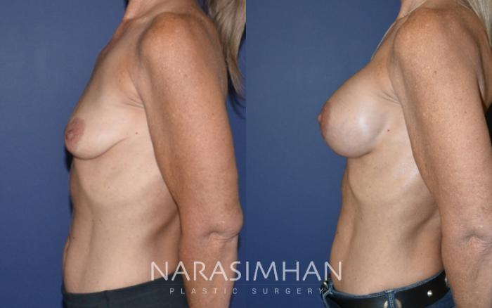 Before & After Breast Augmentation Case 147 View #3 View in Tampa, Florida