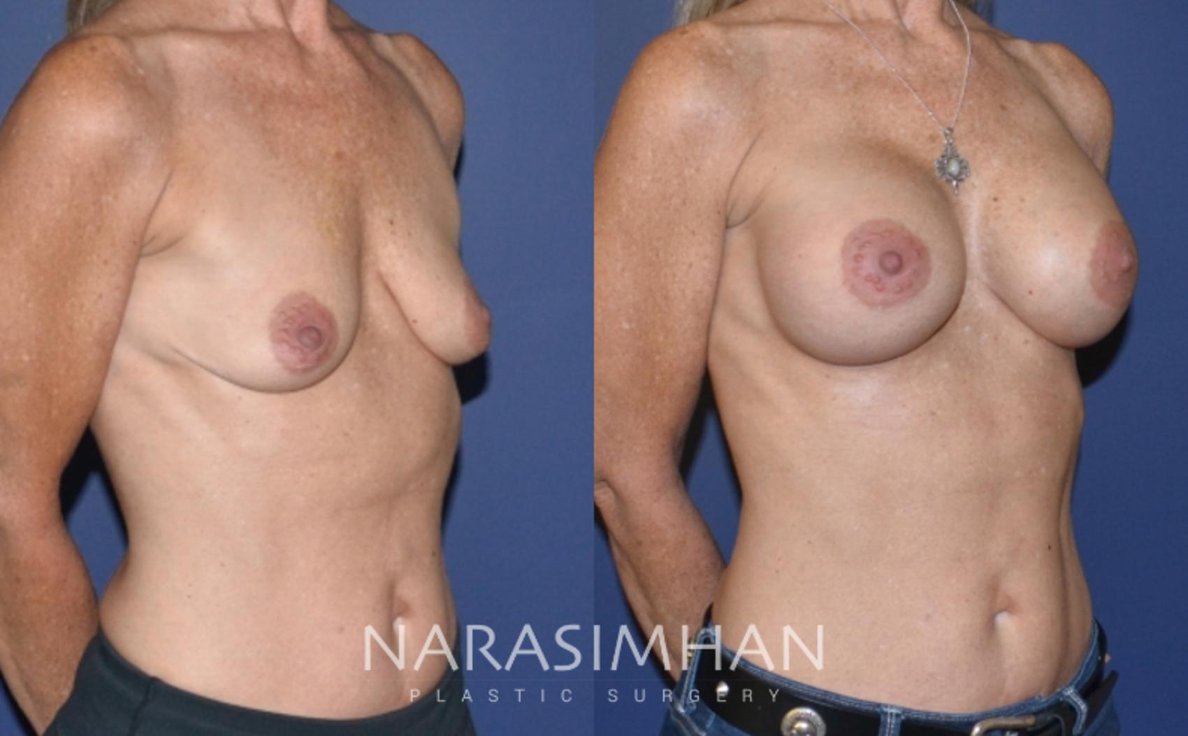 Before & After Breast Augmentation Case 147 View #4 View in St. Petersburg, Florida