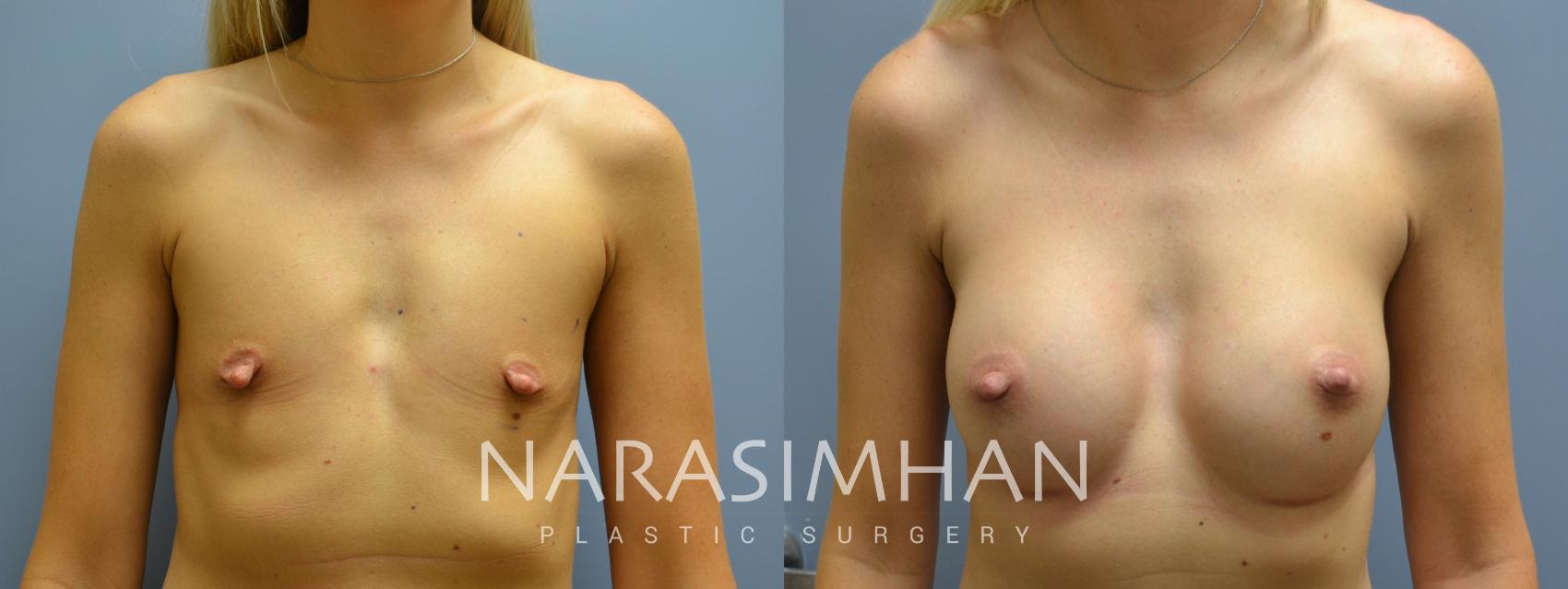 Before & After Breast Augmentation Case 163 View #1 View in St. Petersburg, Florida