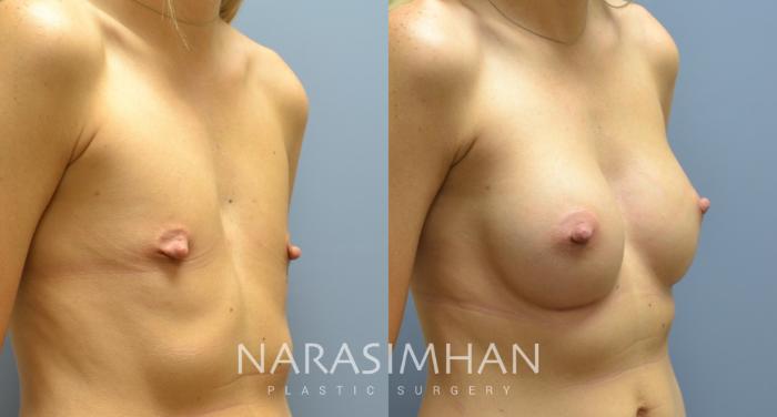 Before & After Breast Augmentation Case 163 View #2 View in St Petersburg, Florida