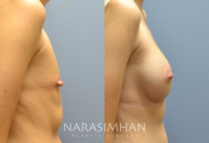 Before & After Breast Augmentation Case 163 View #3 View in St Petersburg, Florida