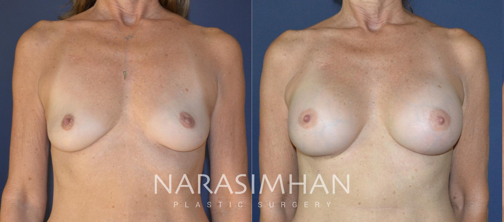 Before & After Breast Augmentation Case 164 View #1 View in St. Petersburg, Florida