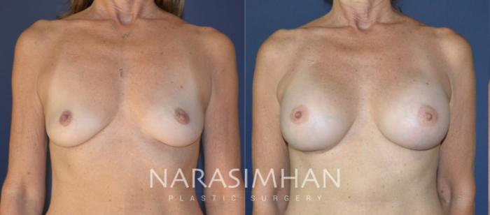 Before & After Breast Augmentation Case 164 View #1 View in Tampa, Florida