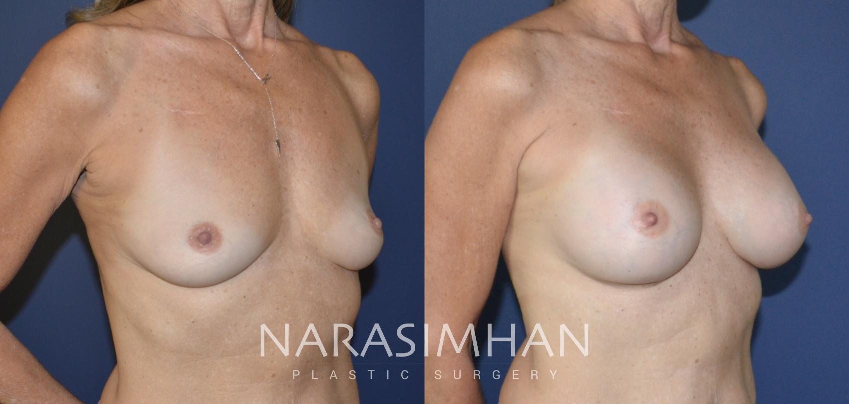 Before & After Breast Augmentation Case 164 View #2 View in St Petersburg, Florida