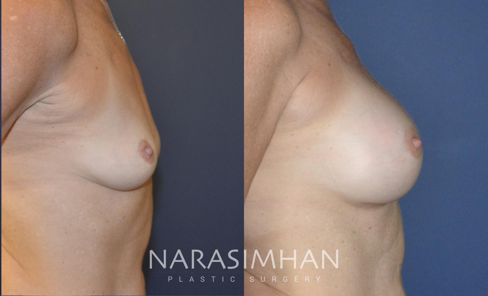 Before & After Breast Augmentation Case 164 View #3 View in St Petersburg, Florida