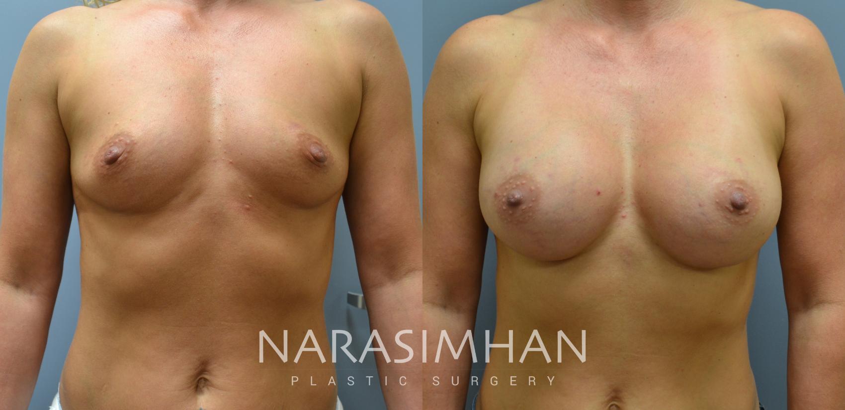 Before & After Breast Augmentation Case 17 View #1 View in St. Petersburg, Florida