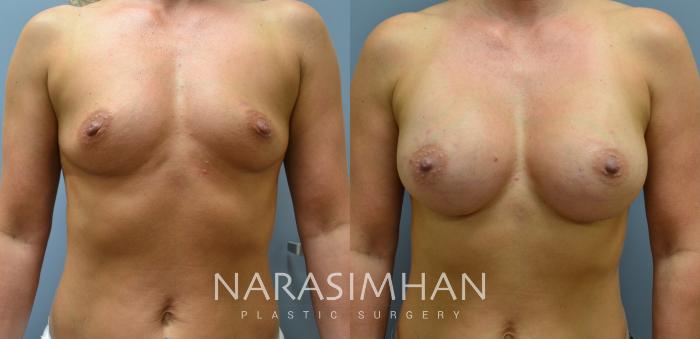 Before & After Breast Augmentation Case 17 View #1 View in Tampa, Florida