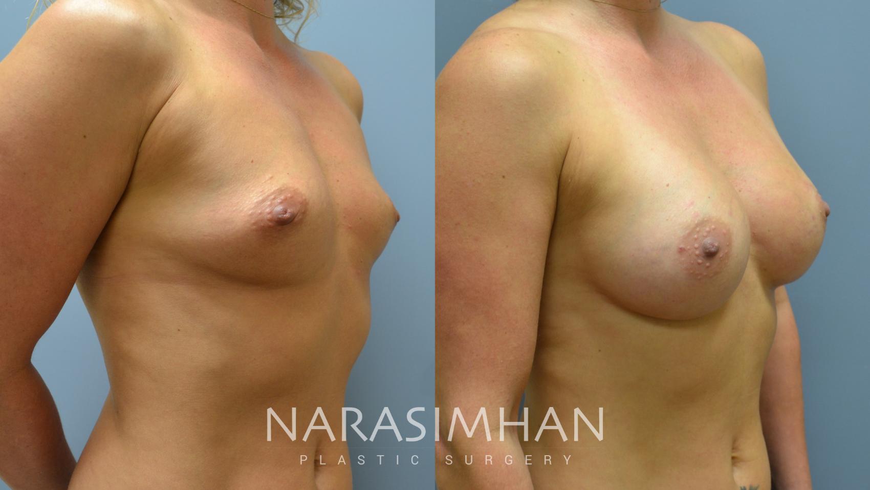 Before & After Breast Augmentation Case 17 View #2 View in St. Petersburg, Florida