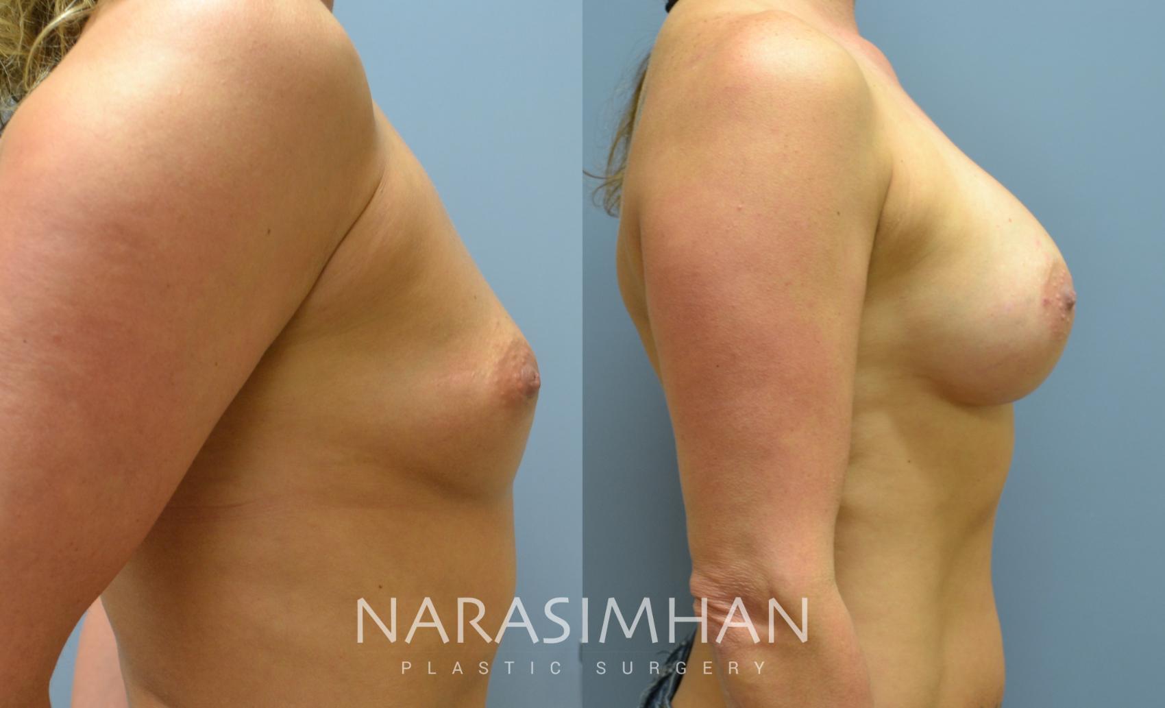 Before & After Breast Augmentation Case 17 View #3 View in St. Petersburg, Florida