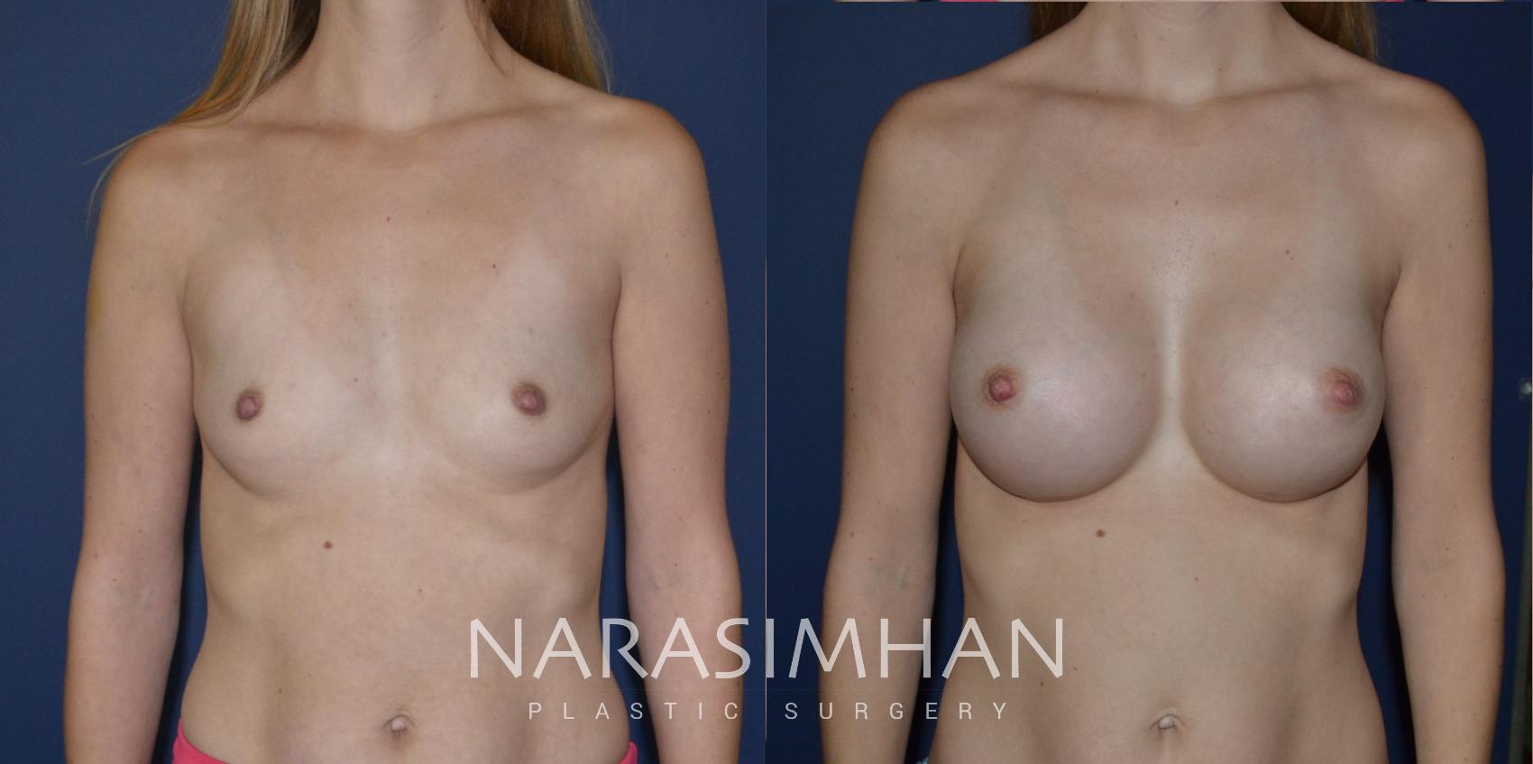 Before & After Breast Augmentation Case 185 View #1 View in St Petersburg, Florida
