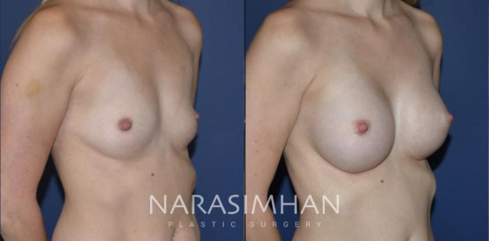 Before & After Breast Augmentation Case 185 View #2 View in St Petersburg, Florida
