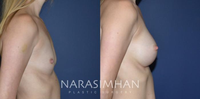 Before & After Breast Augmentation Case 185 View #3 View in St Petersburg, Florida