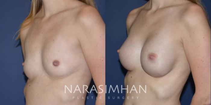 Before & After Breast Augmentation Case 185 View #4 View in St Petersburg, Florida