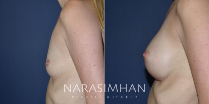 Before & After Breast Augmentation Case 185 View #5 View in St Petersburg, Florida