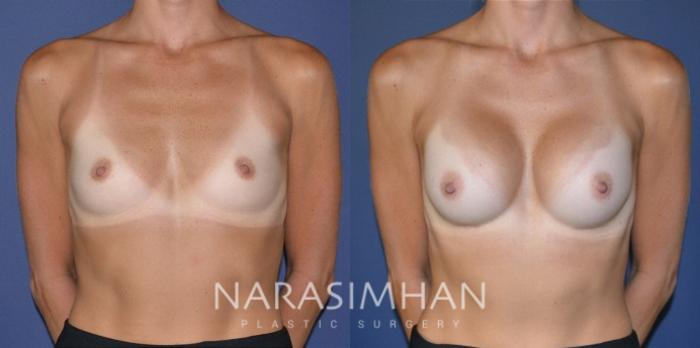 Before & After Breast Augmentation Case 187 View #1 View in St Petersburg, Florida