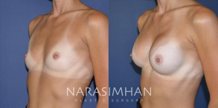 Before & After Breast Augmentation Case 187 View #2 View in St Petersburg, Florida