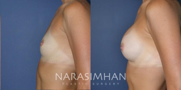 Before & After Breast Augmentation Case 187 View #3 View in St Petersburg, Florida