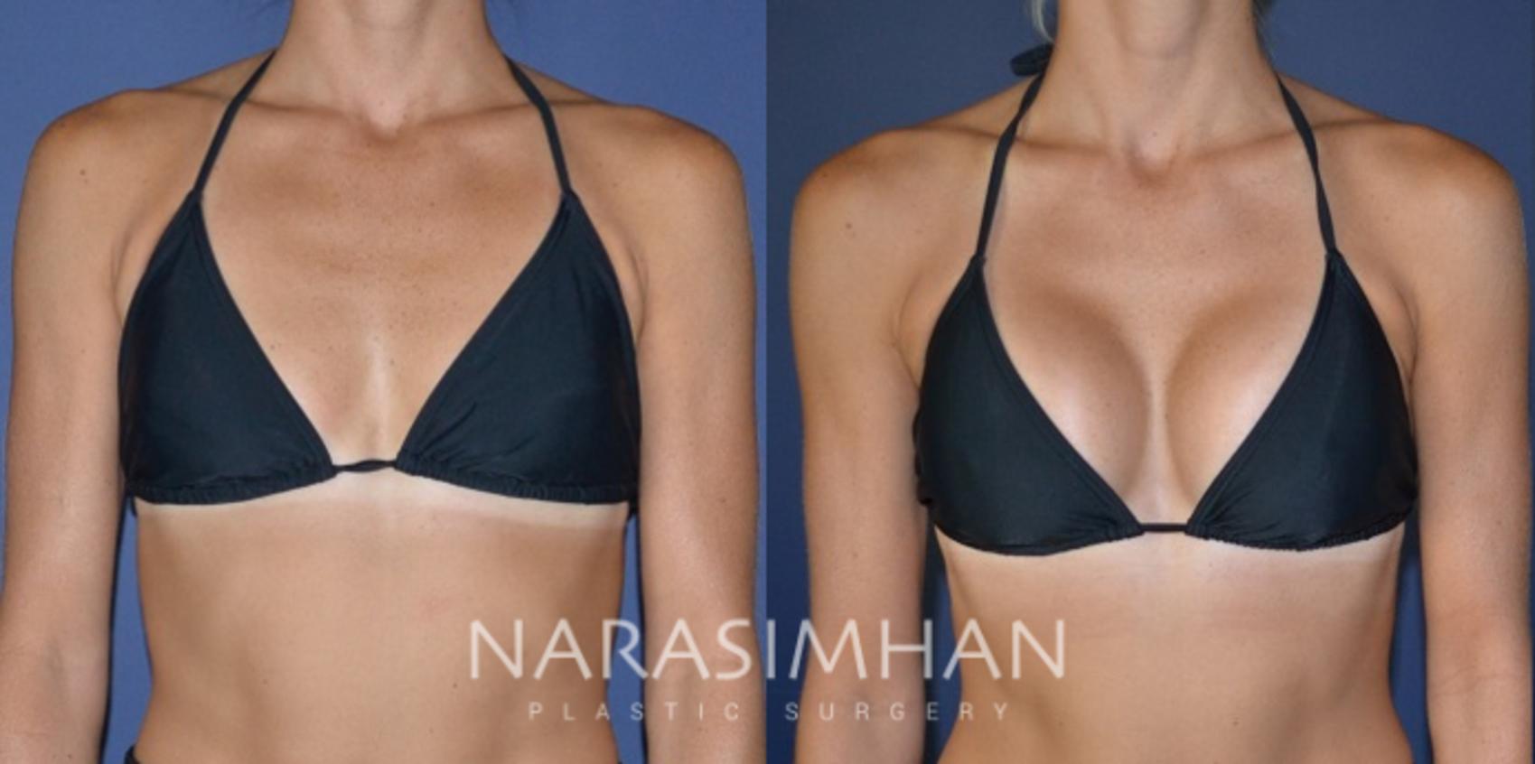 Before & After Breast Augmentation Case 187 View #4 View in St. Petersburg, Florida