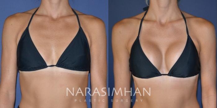 Before & After Breast Augmentation Case 187 View #4 View in St Petersburg, Florida