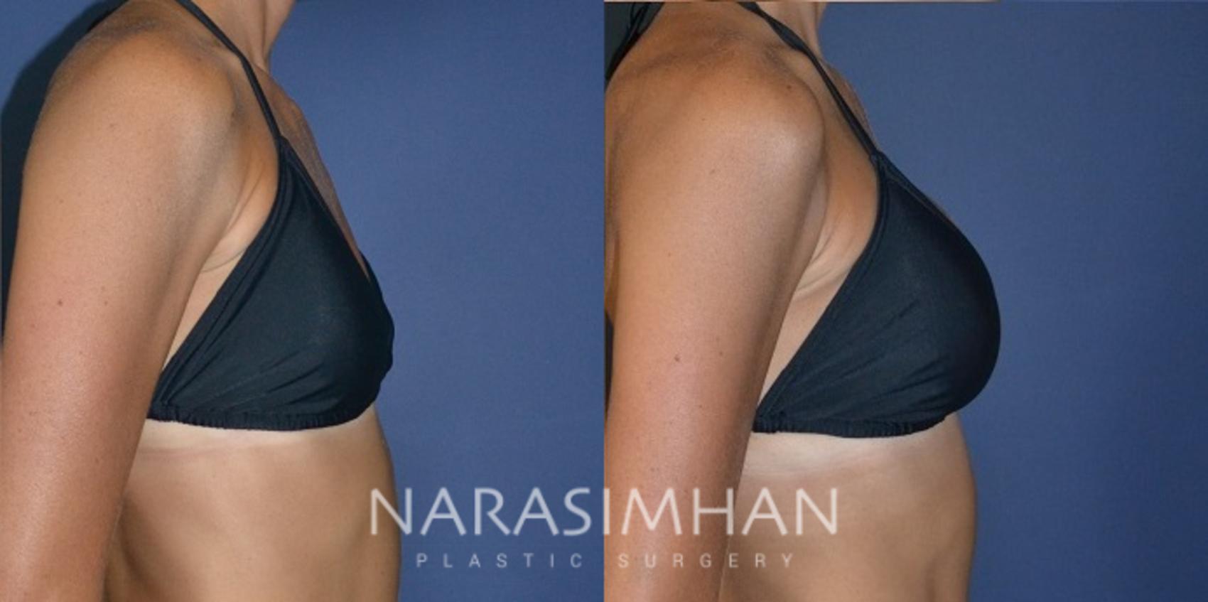 Before & After Breast Augmentation Case 187 View #5 View in St. Petersburg, Florida