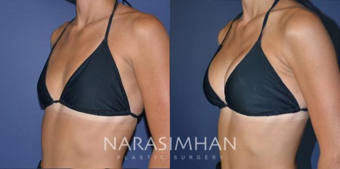 Before & After Breast Augmentation Case 187 View #6 View in St Petersburg, Florida