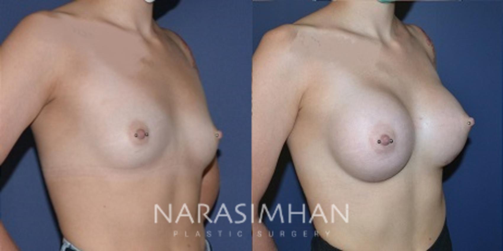Before & After Breast Augmentation Case 188 View #1 View in St Petersburg, Florida