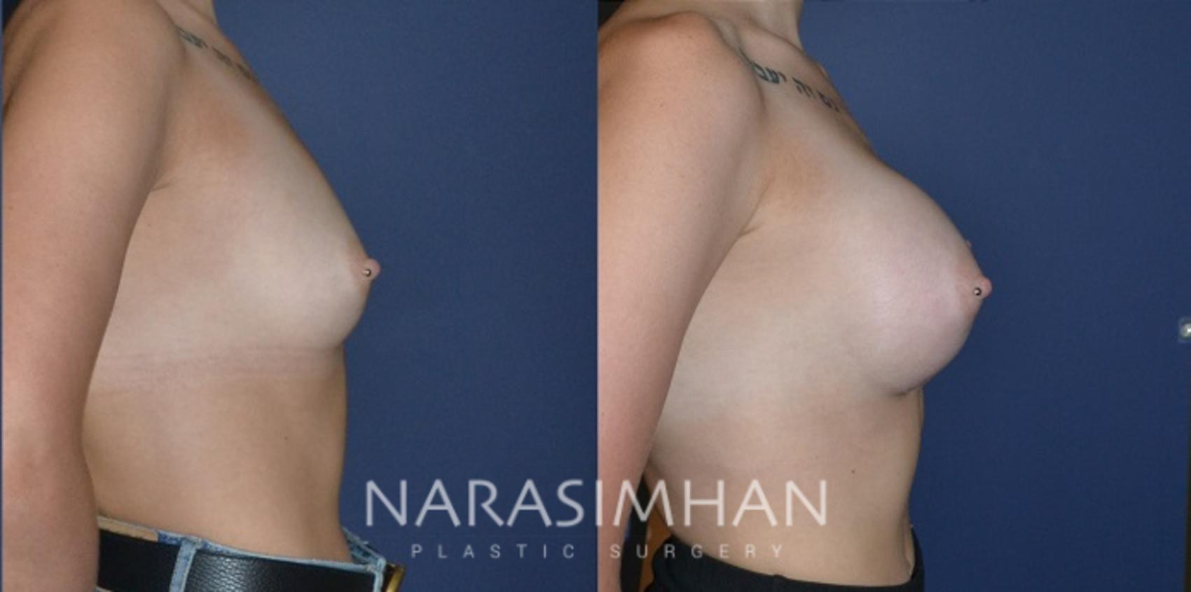 Before & After Breast Augmentation Case 188 View #2 View in St Petersburg, Florida