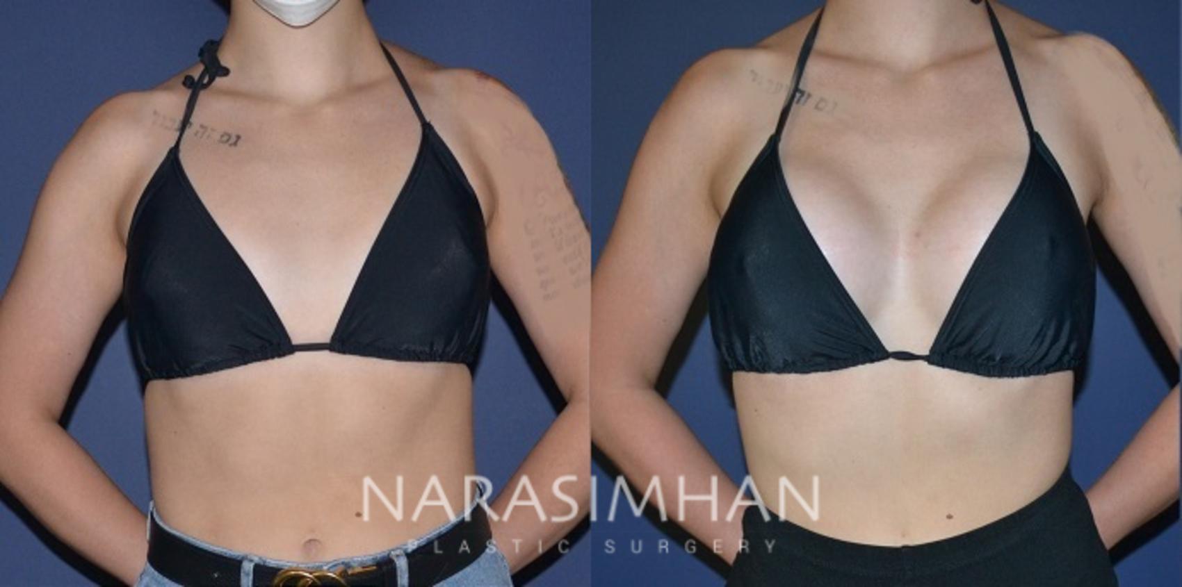 Before & After Breast Augmentation Case 188 View #3 View in St Petersburg, Florida