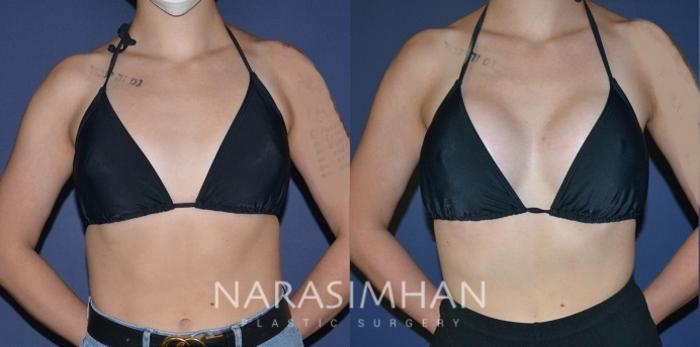Before & After Breast Augmentation Case 188 View #3 View in Tampa, Florida
