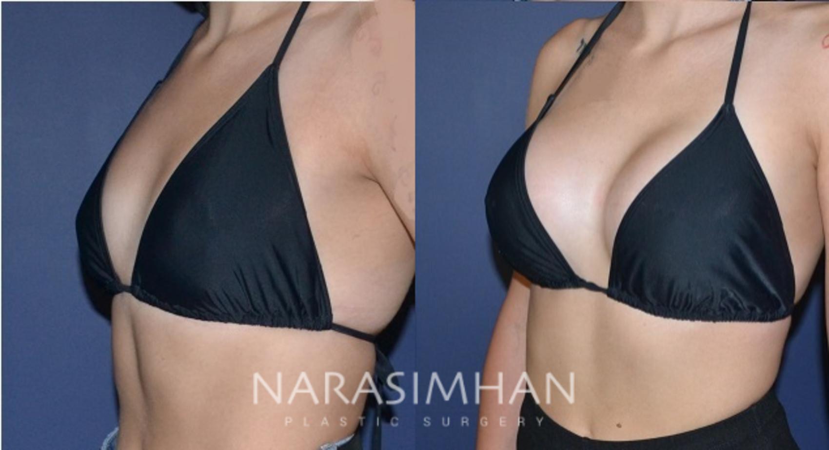 Before & After Breast Augmentation Case 188 View #4 View in St Petersburg, Florida