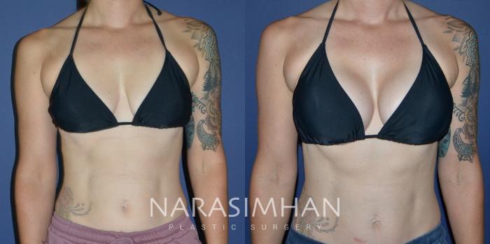 Before & After Breast Augmentation Case 197 View #2 View in Tampa, Florida
