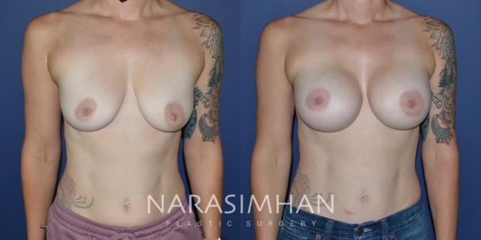 Before & After Breast Augmentation Case 197 View #3 View in Tampa, Florida