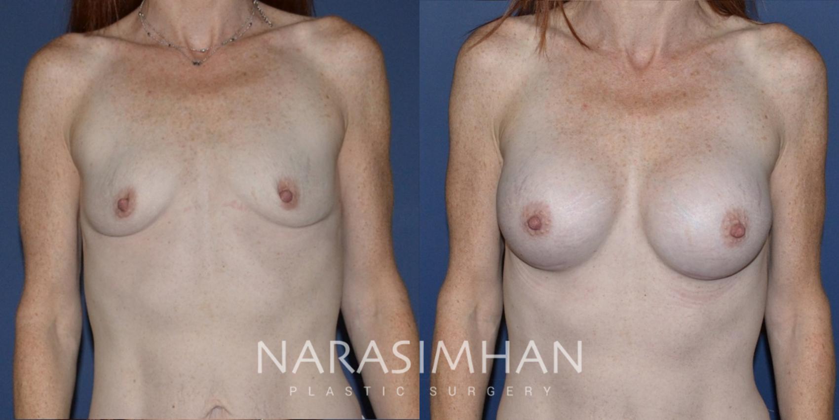 Before & After Breast Augmentation Case 199 View #1 View in Tampa, Florida