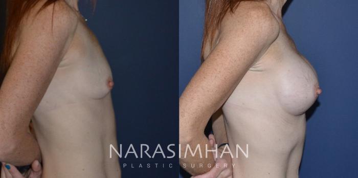 Before & After Breast Augmentation Case 199 View #2 View in Tampa, Florida