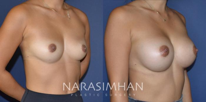 Before & After Breast Augmentation Case 200 View #1 View in Tampa, Florida