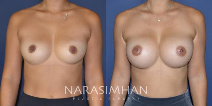 Before & After Breast Augmentation Case 200 View #2 View in Tampa, Florida