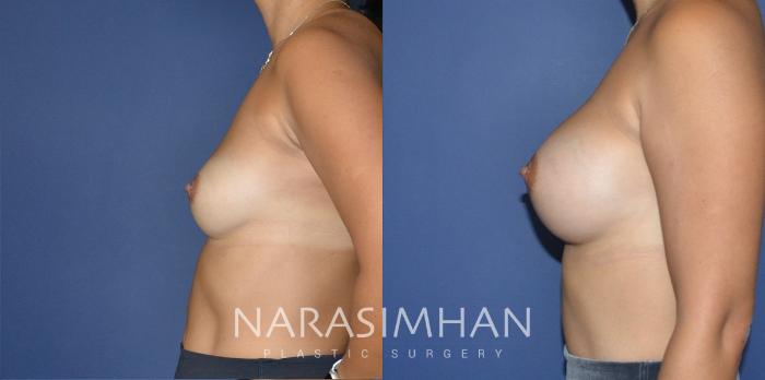Before & After Breast Augmentation Case 200 View #3 View in Tampa, Florida