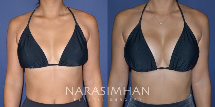 Before & After Breast Augmentation Case 200 View #4 View in Tampa, Florida