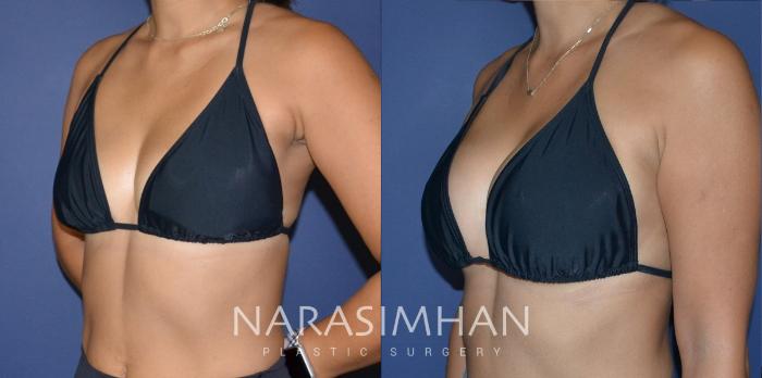 Before & After Breast Augmentation Case 200 View #5 View in Tampa, Florida
