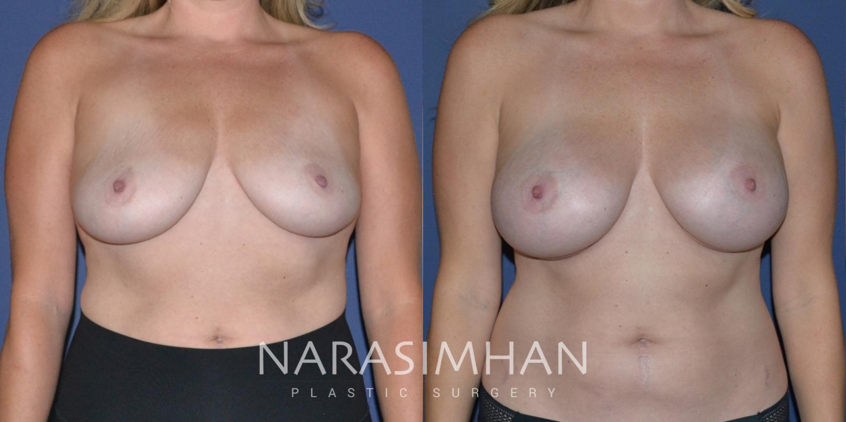 Before & After Breast Augmentation Case 202 View #1 View in Tampa, Florida