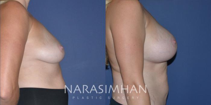 Before & After Breast Augmentation Case 202 View #2 View in Tampa, Florida