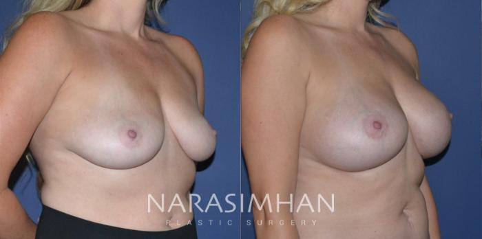 Before & After Breast Augmentation Case 202 View #3 View in Tampa, Florida