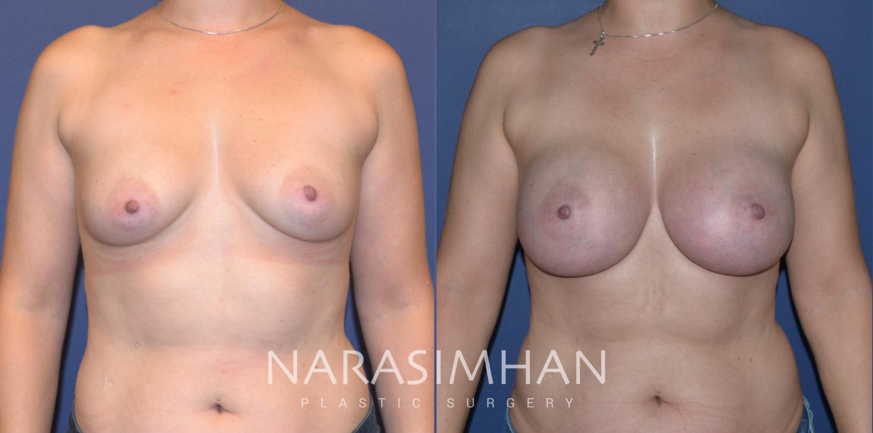 Before & After Breast Augmentation Case 205 View #1 View in Tampa, Florida