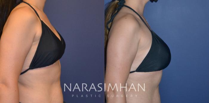 Before & After Breast Augmentation Case 205 View #2 View in Tampa, Florida