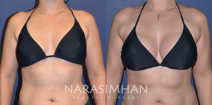 Before & After Breast Augmentation Case 205 View #3 View in Tampa, Florida