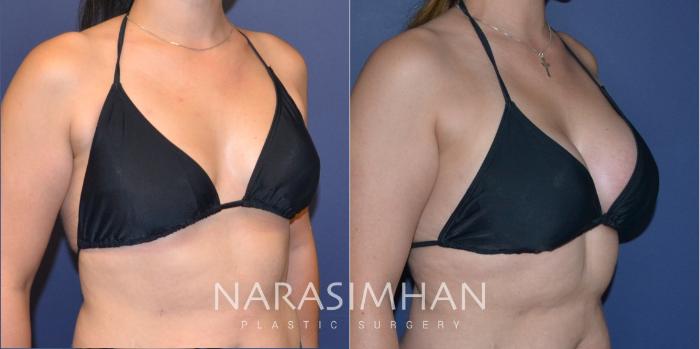 Before & After Breast Augmentation Case 205 View #4 View in Tampa, Florida