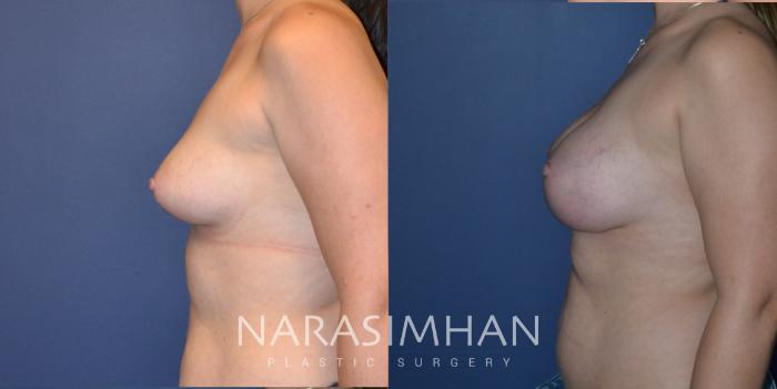 Before & After Breast Augmentation Case 205 View #5 View in Tampa, Florida