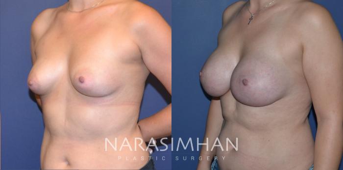 Before & After Breast Augmentation Case 205 View #6 View in Tampa, Florida