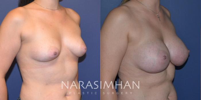 Before & After Breast Augmentation Case 205 View #7 View in Tampa, Florida